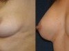 4b-breast-enlargement